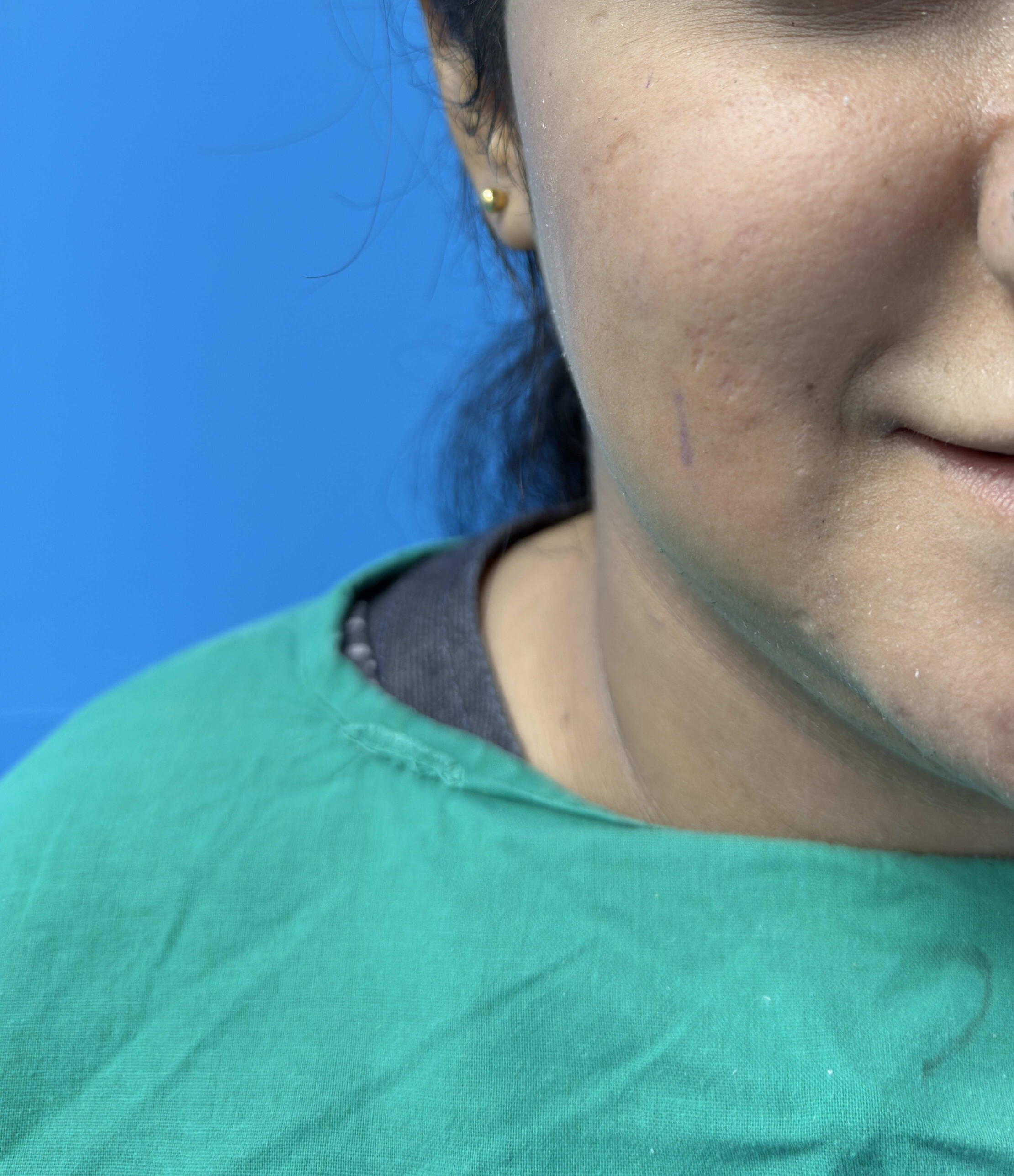 dimple - Before